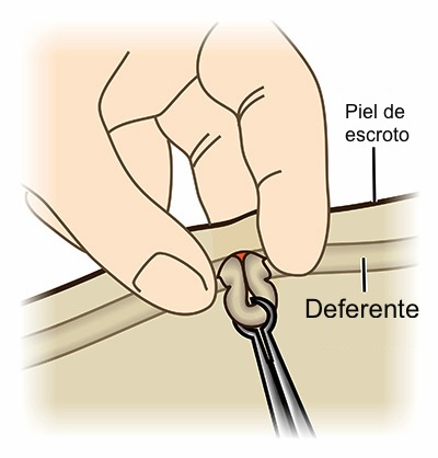 mini vasectomia