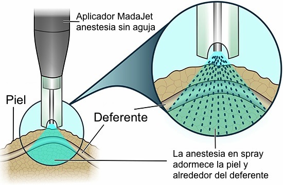 vasectomia sin dolor coru&ntilde;a