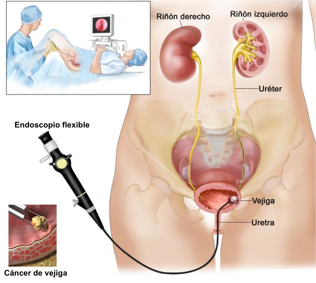 cistoscopia