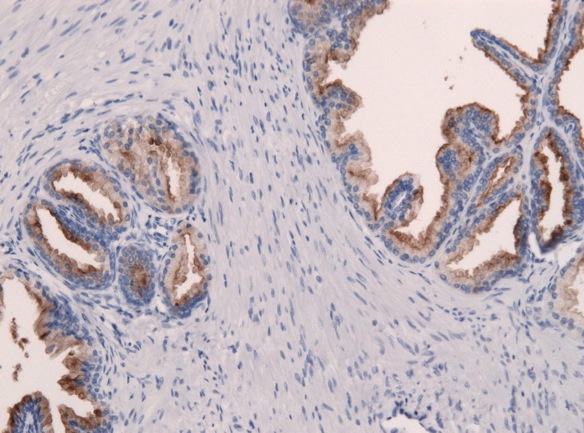 Histologia PSA cancer pr&oacute;stata